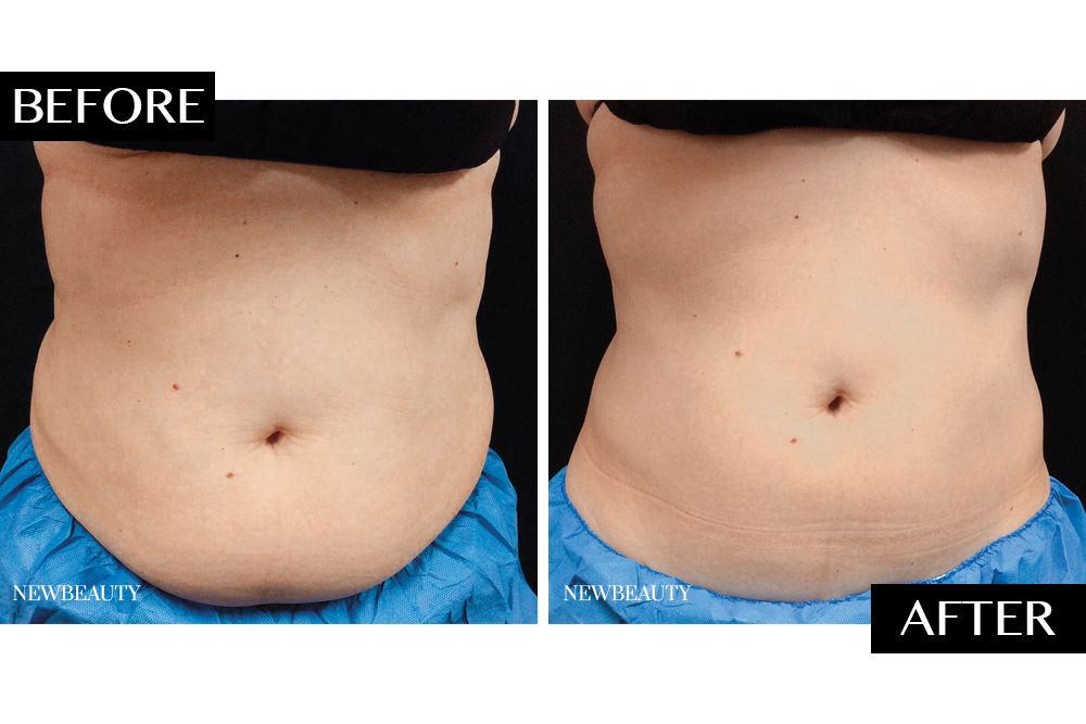 CoolSculpting After Pregnancy  Does CoolSculpting Work on Stomach