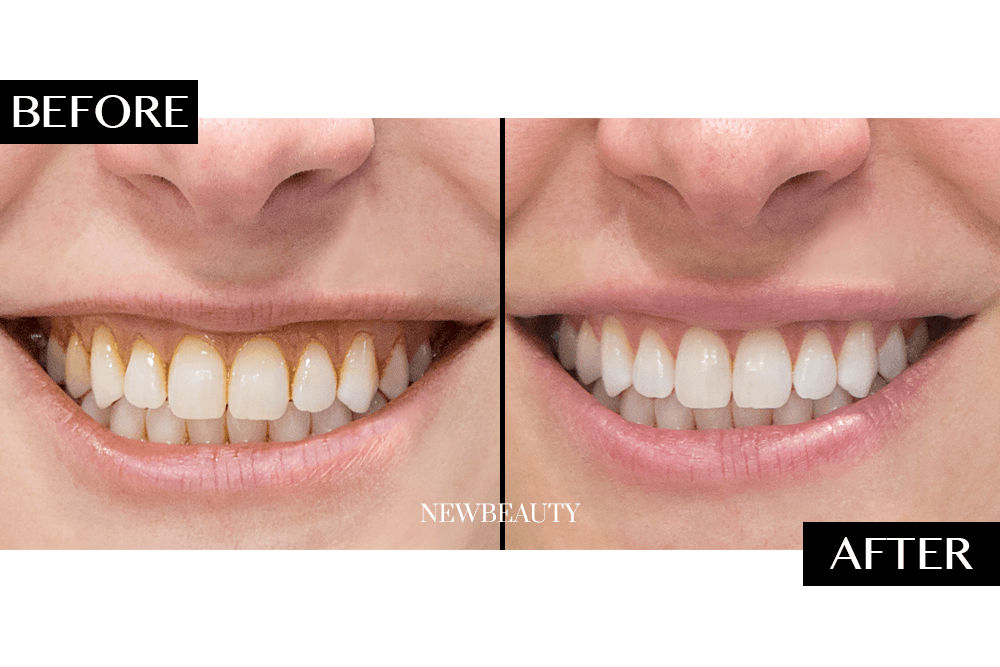 supersmile toothpaste before and after