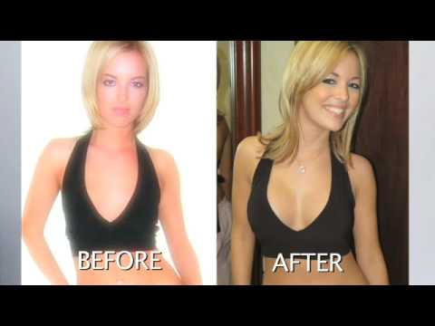 Breast Augmentation- A to a C Cup Before and After