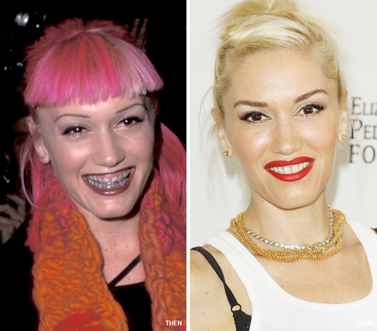 Smile Makeover: Gwen Stefani's Transformation - NewBeauty