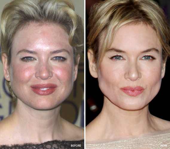 celebrities with bad skin