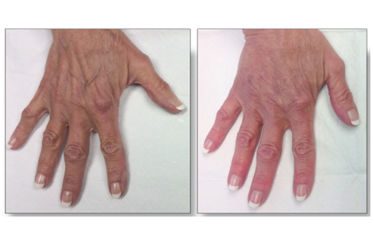 Your Hands May Be Aging You—Here Are 3 Expert-Approved Ways to Turn ...