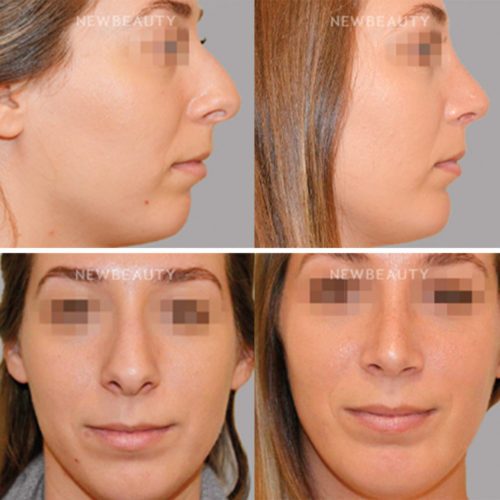 The Trending Combination Surgery That Makes a Huge Difference in Your ...