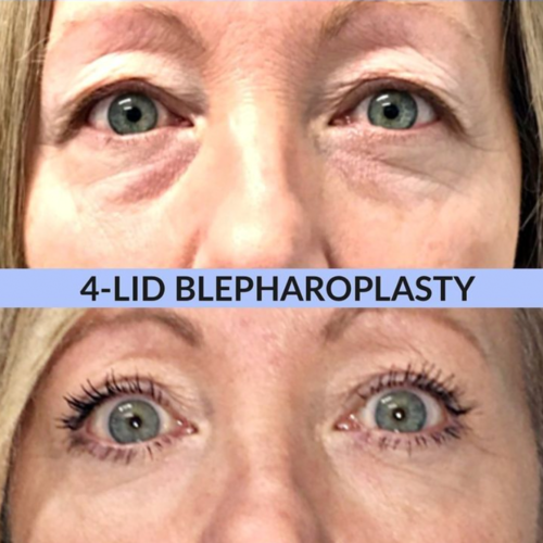 The Eyelid Procedure That’s Big on Results and Short on Downtime ...