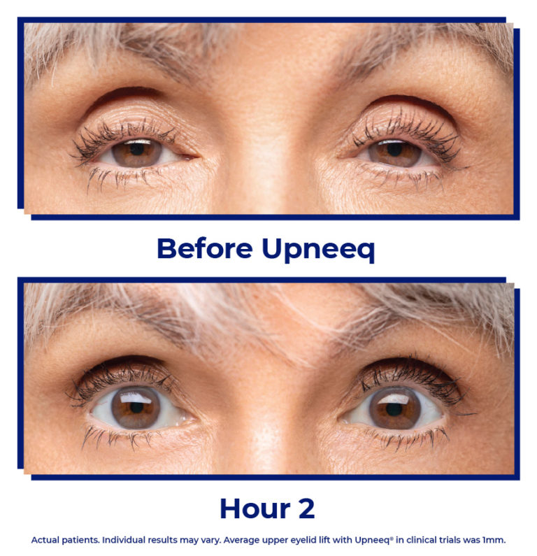 This New Eye Drop Lifts Droopy Eyelids Without Surgery Newbeauty 