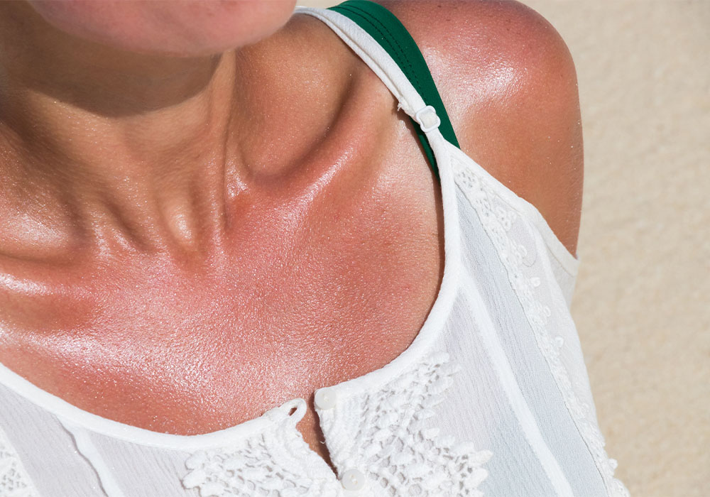 Dermatologists Share What To Do When Your Skin Peels After A Sunburn 