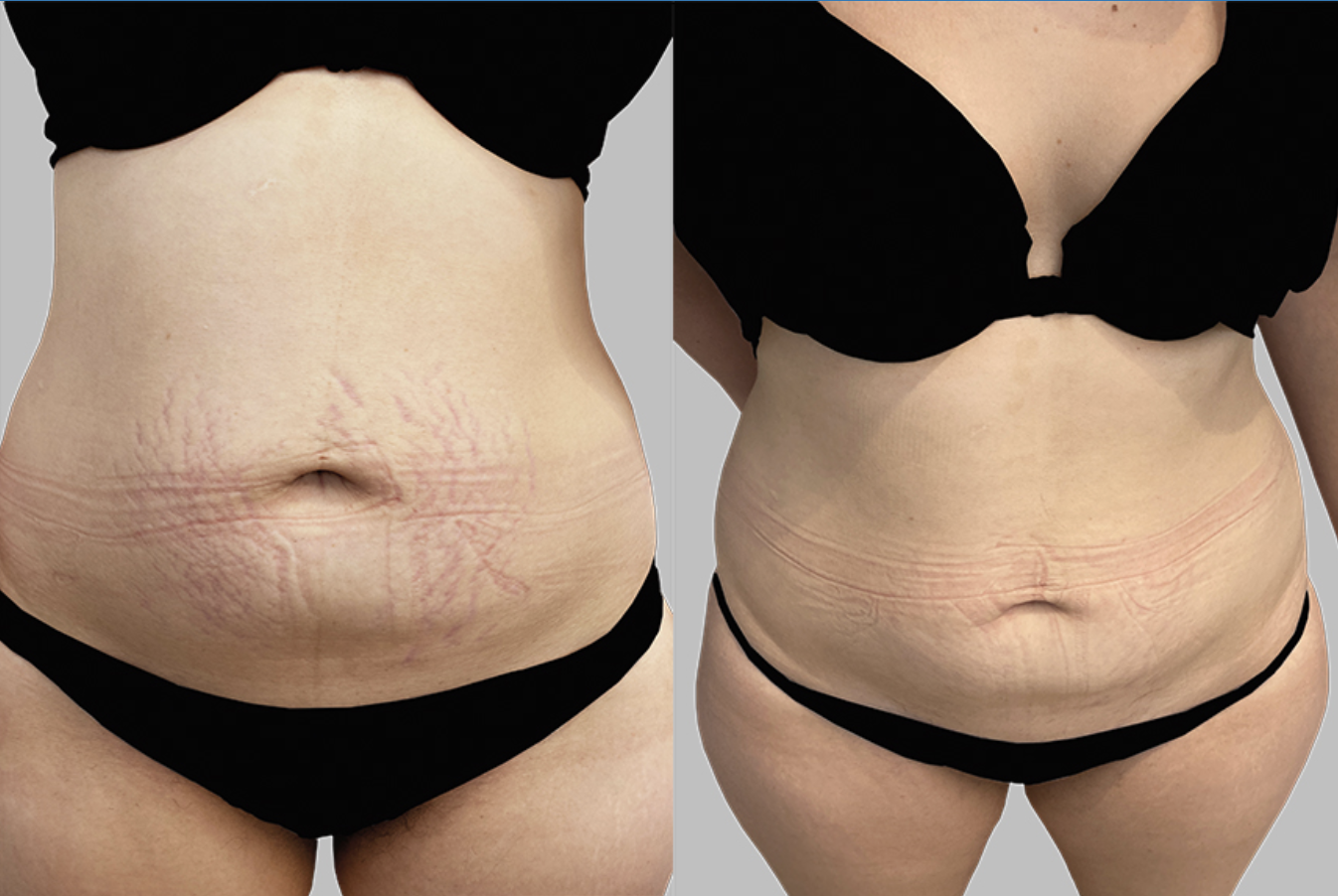 Retin A Before And After Stretch Marks