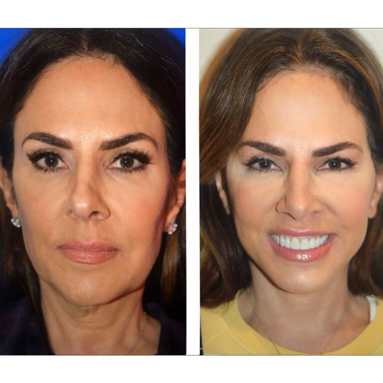 RHONJ’s Jennifer Fessler Talks Getting A Natural-Looking Facelift At 54