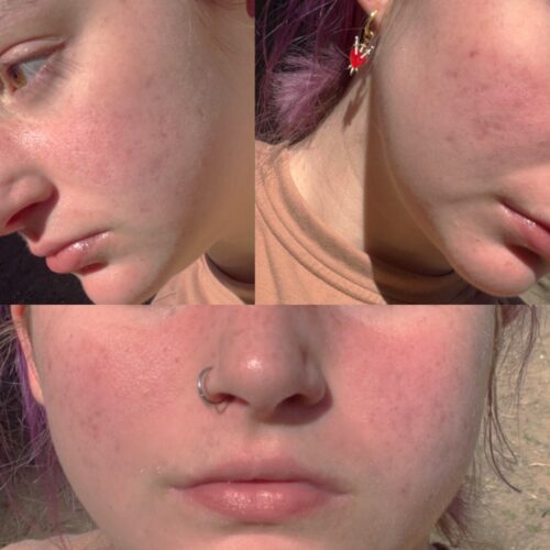 Accutane Before And After What I Wish I Knew About Isotretinoin