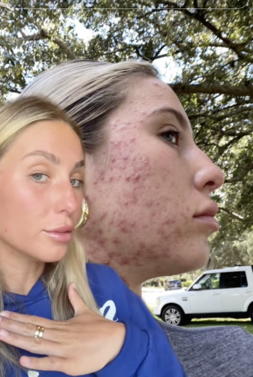 Inside Alix Earle's Accutane Journey: The TikTok Star Opens Up