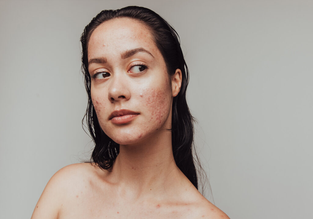 Break Free from Breakouts: Meet AviClear, the Latest in Acne Treatment featured image