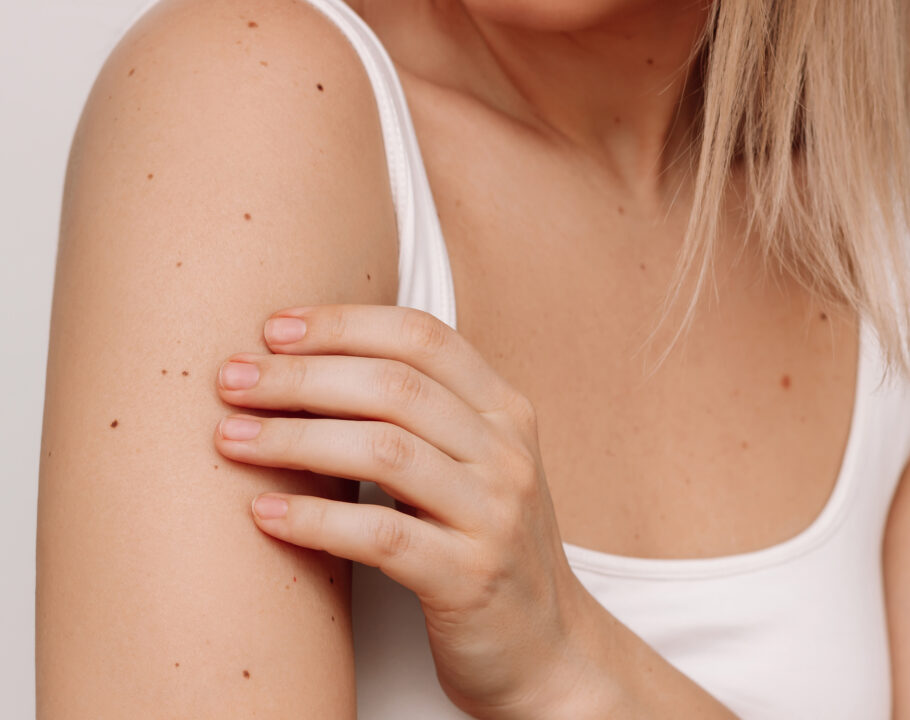 Cropped shot of a young blonde woman with a large number of moles on her arms