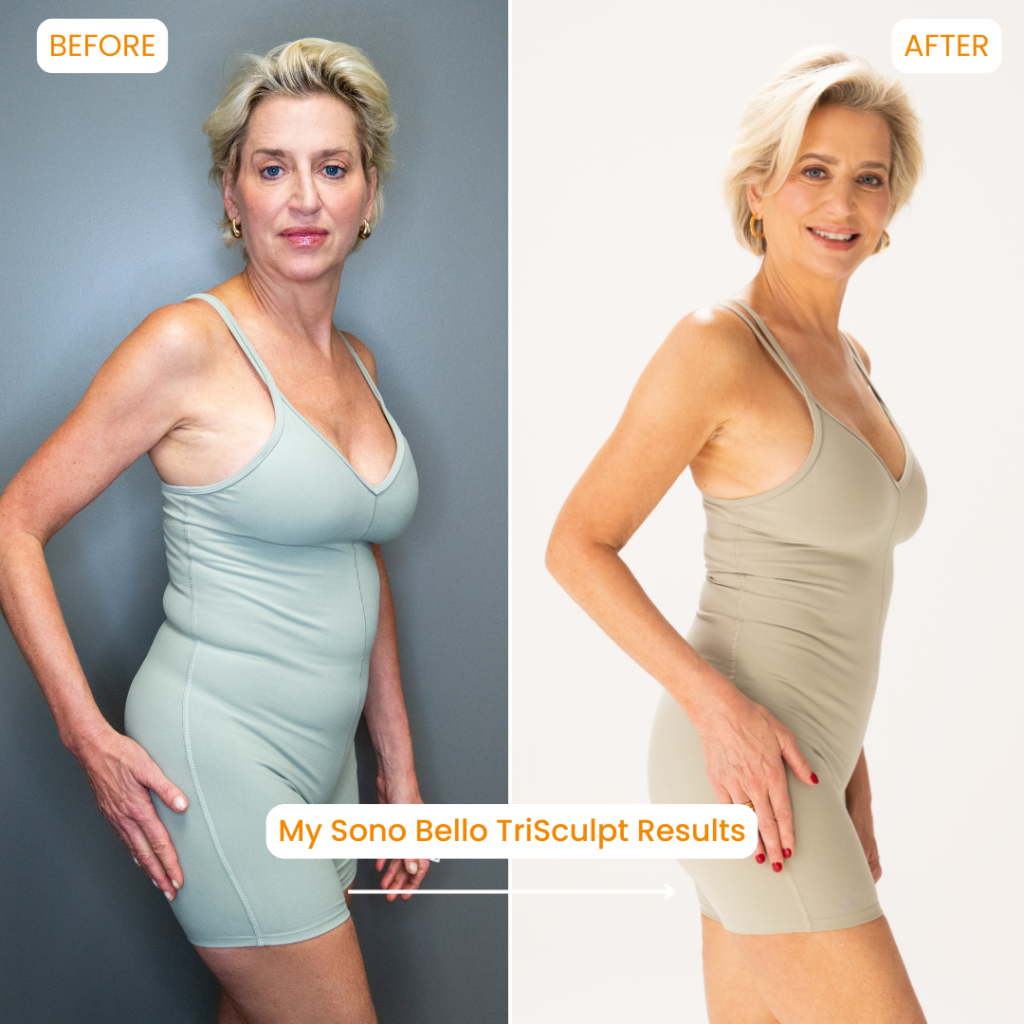 dorinda medley liposuction after