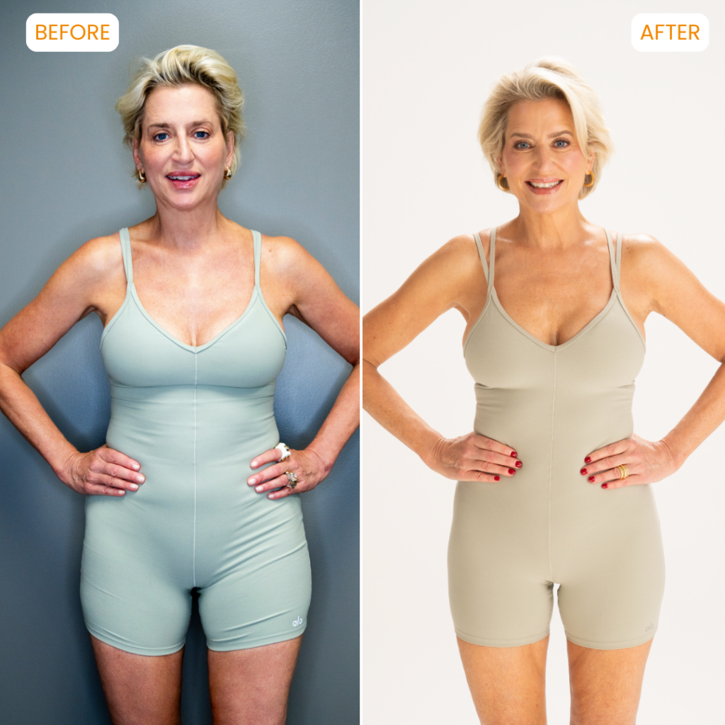 dorinda medley liposuction