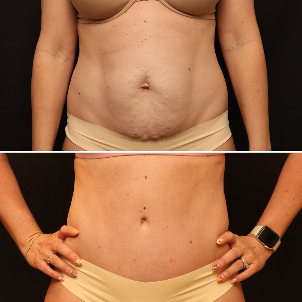 Before and after of a woman's midsection after tummy tuck