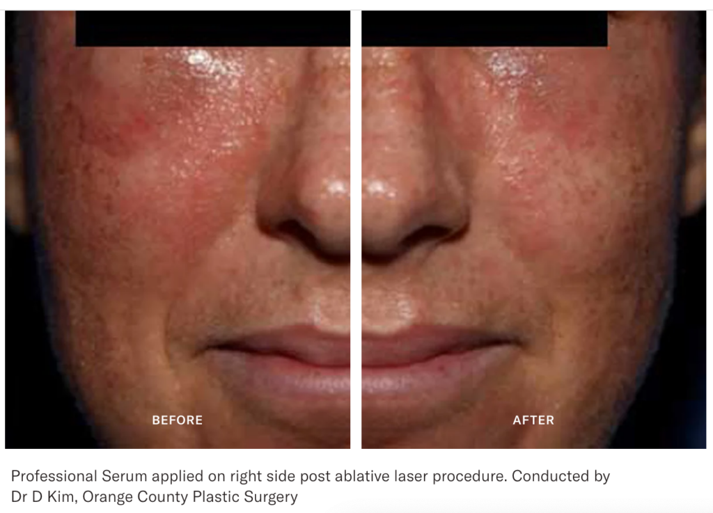 calecim professional serum before and after picture