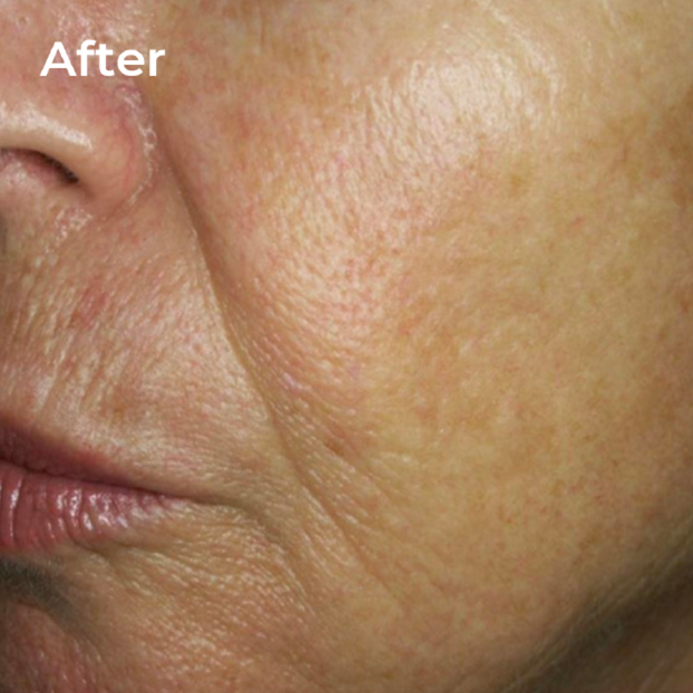 After EnerJet treatment